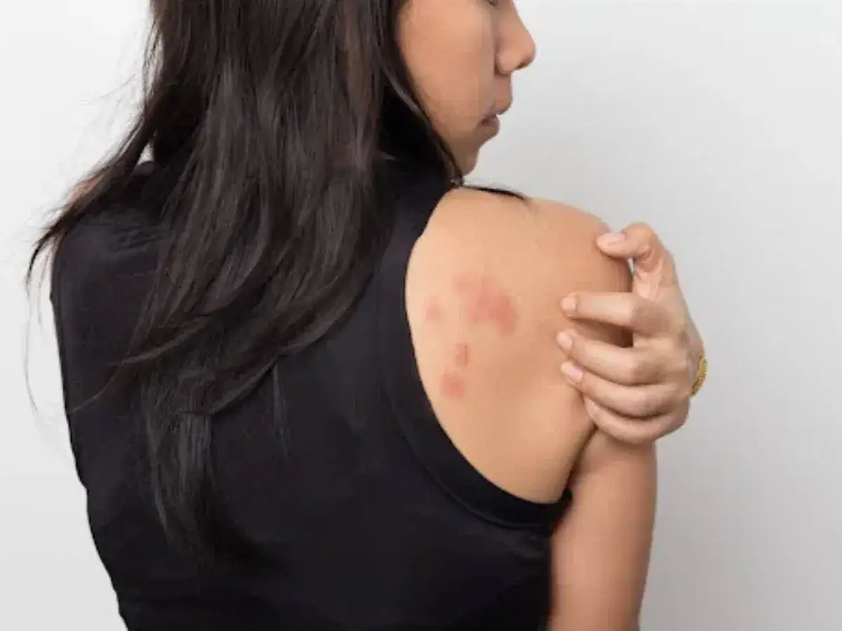 Mujer se rasca el hombro, mostrando manchas en la piel por estrés.