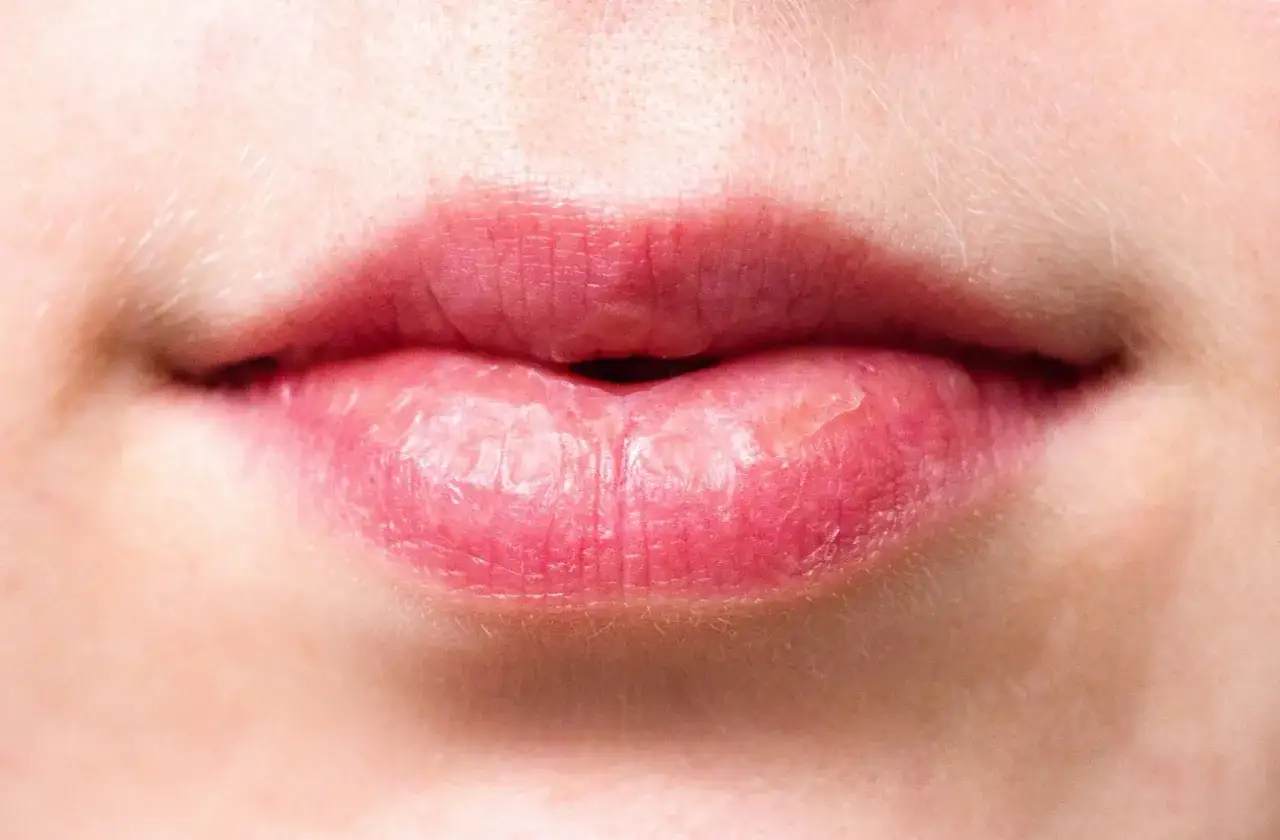 Labios agrietados y secos, con aspecto de labios quemados por el sol, mostrando la necesidad de protección.