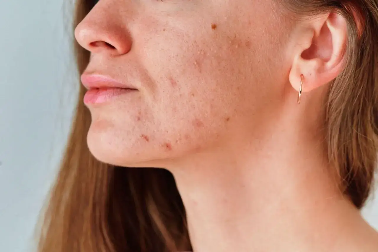 Primer plano de una mujer con granos en el cuello y la mandíbula, mostrando la textura de su piel.