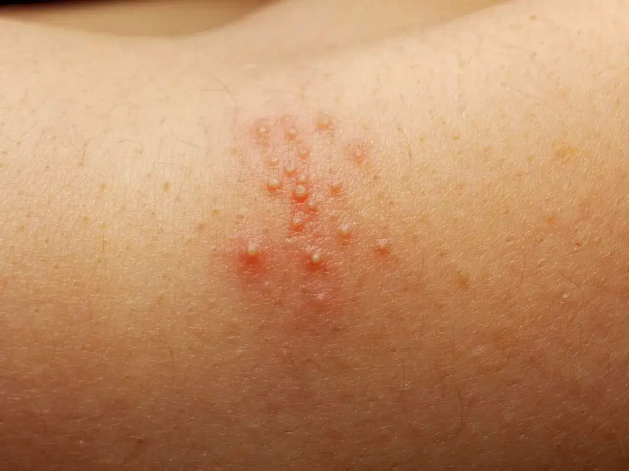 Sarpullido por calor con pequeñas ampollas rojas en la piel.