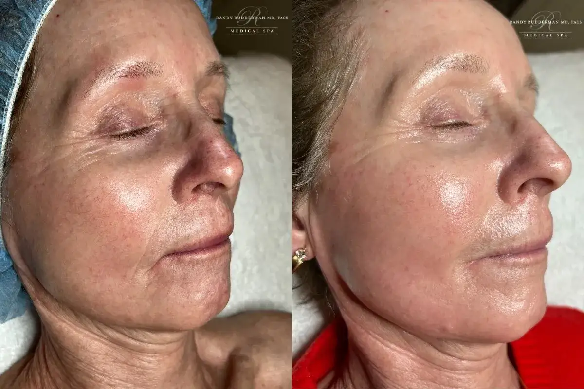 Antes y después de un tratamiento para eliminar manchas de la cara. La piel luce más uniforme y radiante.