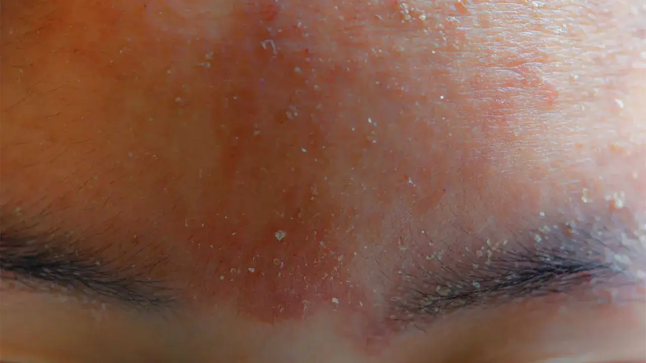 Primer plano de un sarpullido en la cara, con piel enrojecida y escamosa sobre las cejas y la frente.