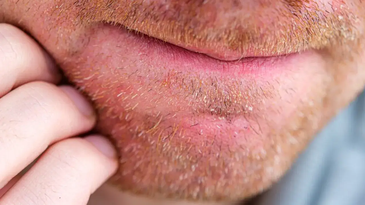Primer plano de una barba con piel enrojecida y escamosa, indicativo de dermatitis barba. Un dedo rasca la zona irritada.