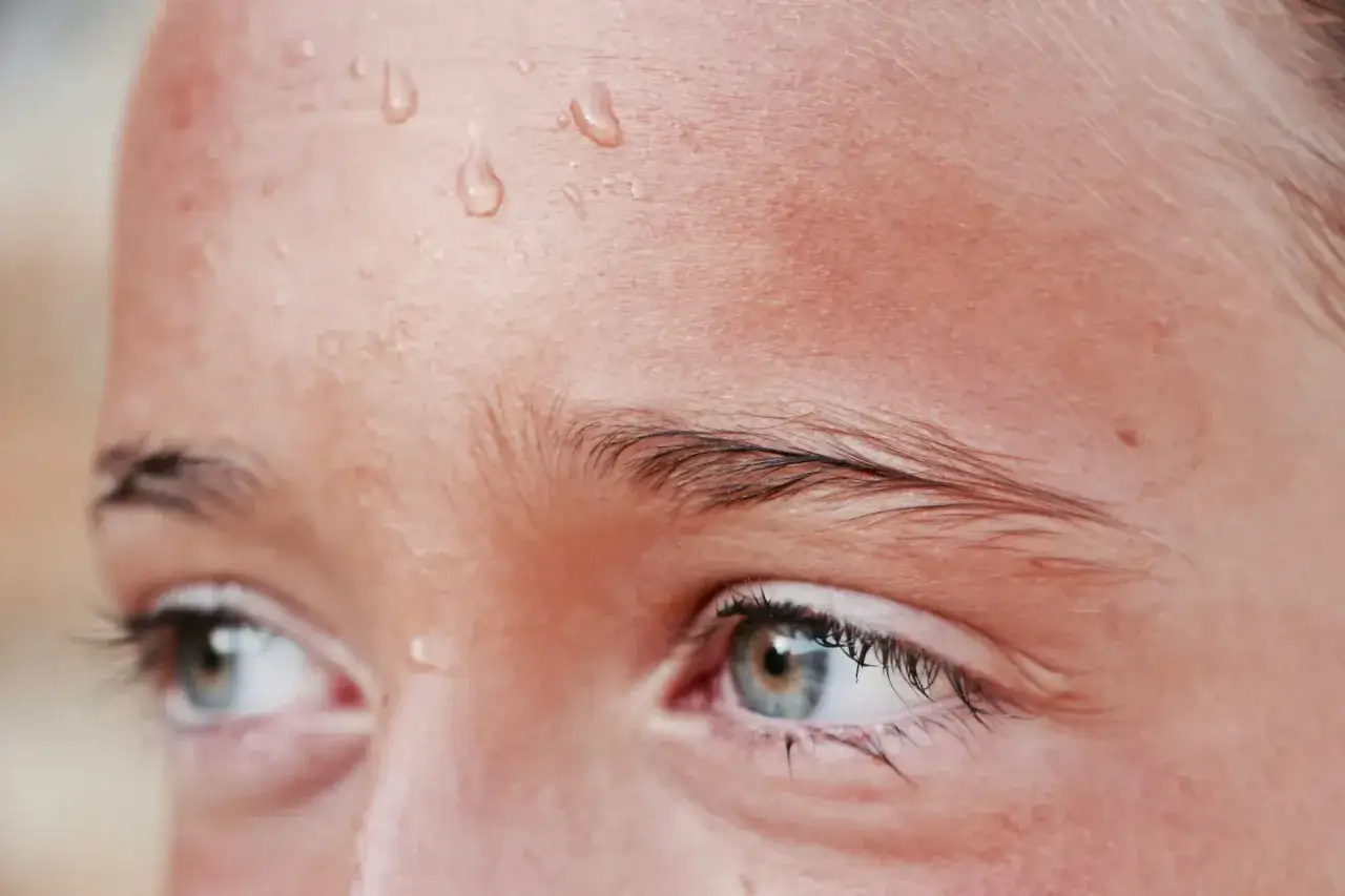 Gotas de sudor en la frente de una persona, un claro ejemplo de hiperhidrosis facial.
