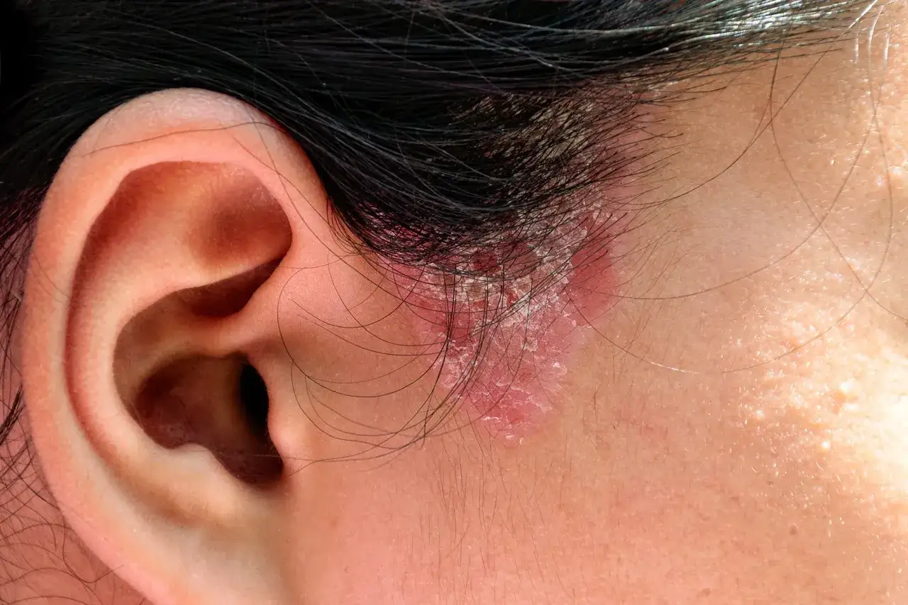 Primer plano de una oreja y el cuero cabelludo con una zona roja y escamosa, indicativa de tiña en la piel.