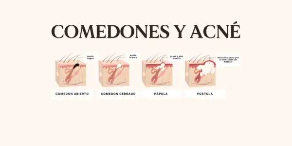 Ilustración explica porque salen puntos negros en la cara: comedón abierto, cerrado, pápula y pústula, mostrando la acumulación de grasa y piel muerta.