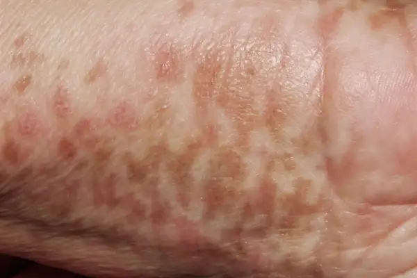 Piel con manchas marrones y rosadas, indicativas de hiperpigmentación postinflamatoria.