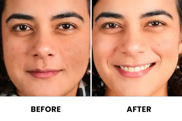 Comparación antes y después de una cara. La piel luce más uniforme y radiante tras el uso de vitaminas.