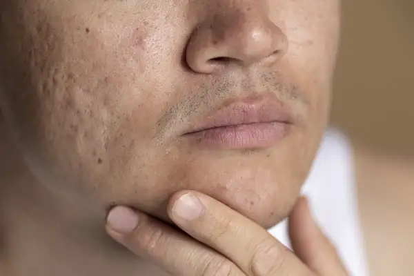 Primer plano de un rostro con marcas de acné. Se muestra la mejilla, la nariz y la boca, con una mano tocando la barbilla. Una guía sobre como quitar marcas de acne.