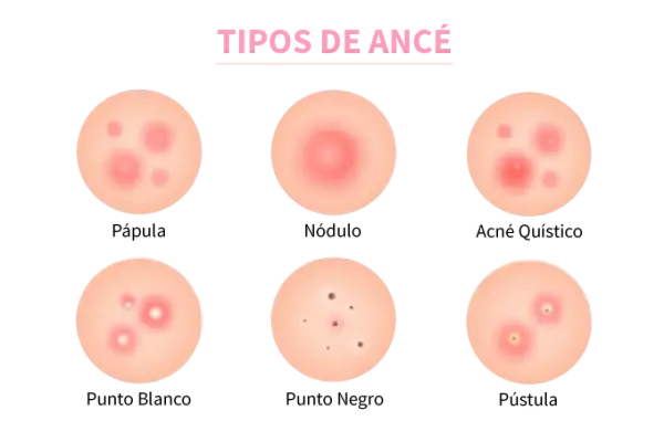 Ilustración de varios tipos de acné: pápula, nódulo, acné quístico, punto blanco, punto negro y pústula.