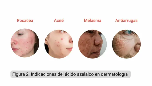 Indicaciones del ácido azelaico: rosácea, acné, melasma y antiarrugas.