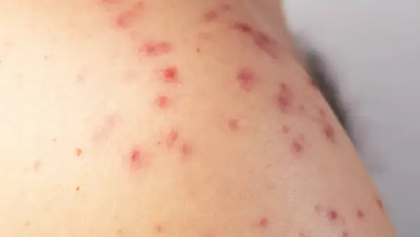 Primer plano de piel con múltiples ronchas rojas, algunas con pequeños puntos blancos, indicando una posible irritación o reacción cutánea.