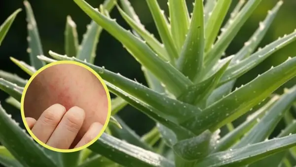 Primer plano de una planta de aloe vera con un círculo que muestra una piel irritada y enrojecida, sugiriendo contraindicaciones del aloe vera en la piel.
