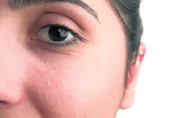 Primer plano del ojo y mejilla de una persona con pequeños quistes de milium blancos visibles en la piel.