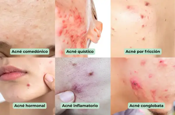 Primer plano de diferentes tipos de acné, incluyendo acné en la frente, quístico, por fricción, hormonal, inflamatorio y   conglobata.