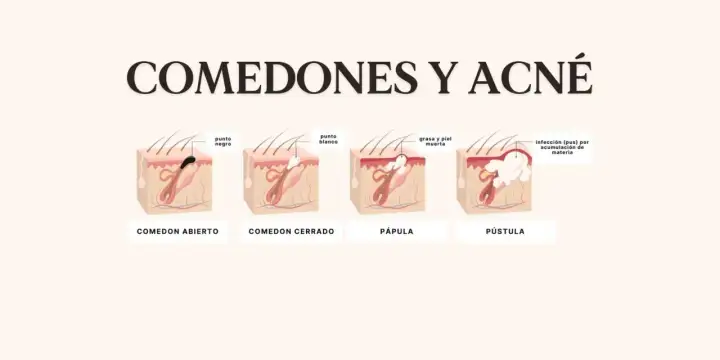 Ilustración explica porque salen puntos negros en la cara: comedón abierto, cerrado, pápula y pústula, mostrando la acumulación de grasa y piel muerta.